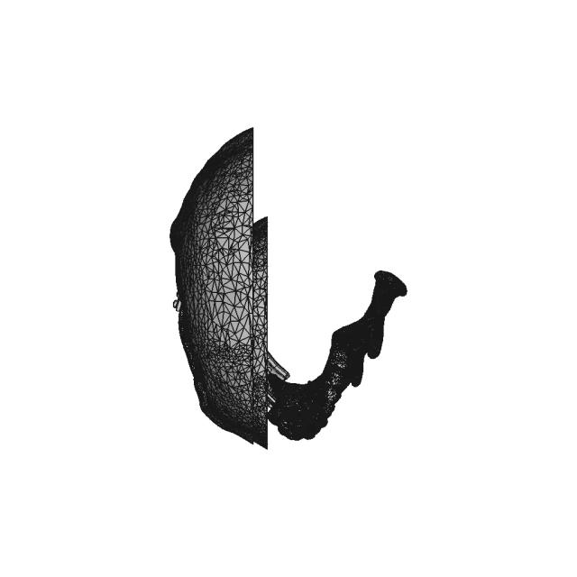 Jaw'S Patient Specific Implant - Standard Mechanical Component