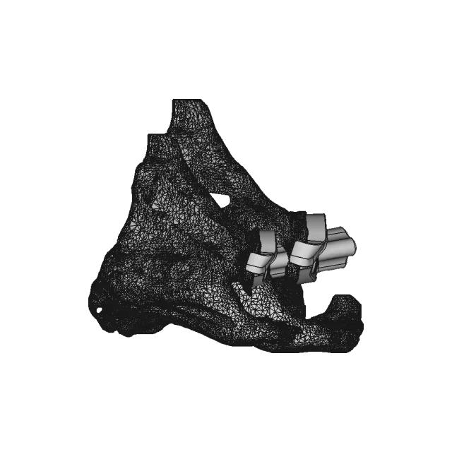 Patient-Specific Shoulder Implant - Standard Mechanical Component