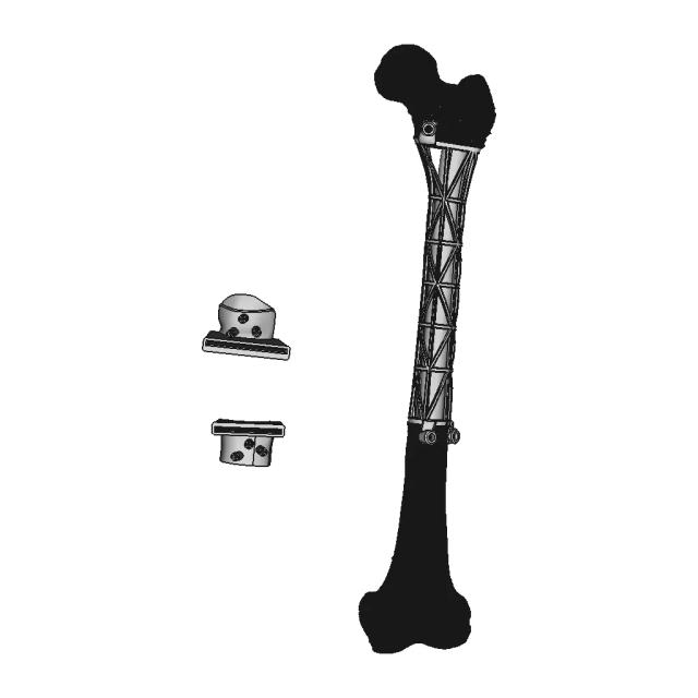 Individual Femoral Implant On The Type Of Truss | 3D Engineering Design File