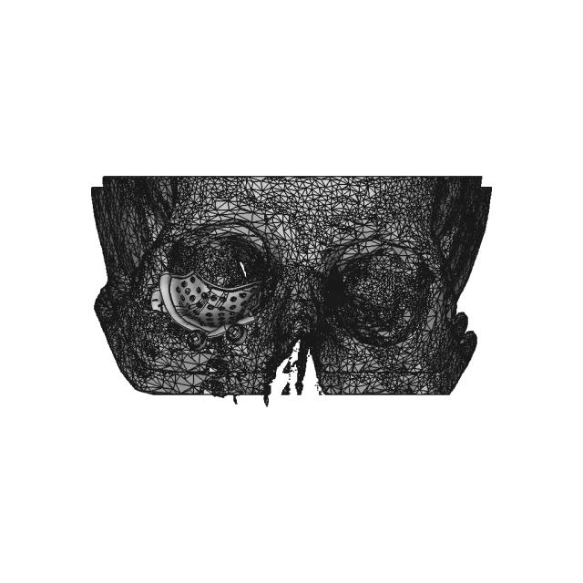 Eye Orbit Prosthetic | High-Quality CAD Model